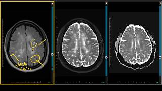 Demyelination Case Review  ADC Negative Multiple Sclerosis [upl. by Zetnod958]