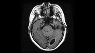 Periventricular leukomalacia Axial T2 FLAIR [upl. by Legnaesoj532]