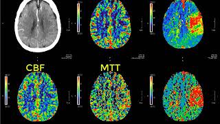 Introduction to CT perfusion before Call [upl. by Lerrehs319]