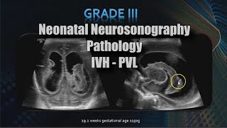 Neonatal Neurosonography  Pathology  IVH  PVL [upl. by Rihana]